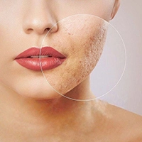 laser acne treatment machine