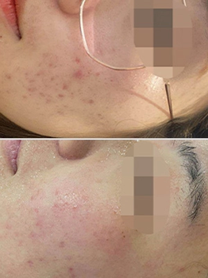 Acne scar laser treatment before after