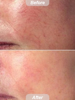 Facial Spider Vein Laser Treatment