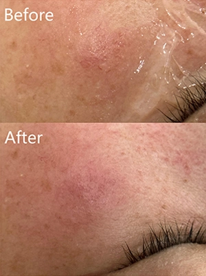 Laser Treatment for Spider Angioma on Face