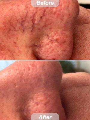 Laser Treatment for Spider Angioma