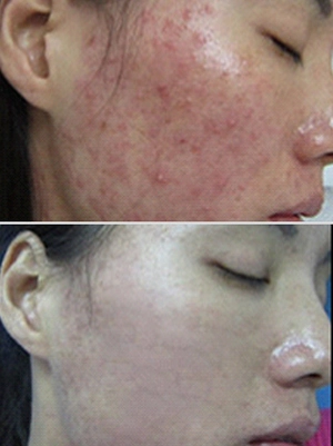 Laser Treatment for Acne Scars Before and After