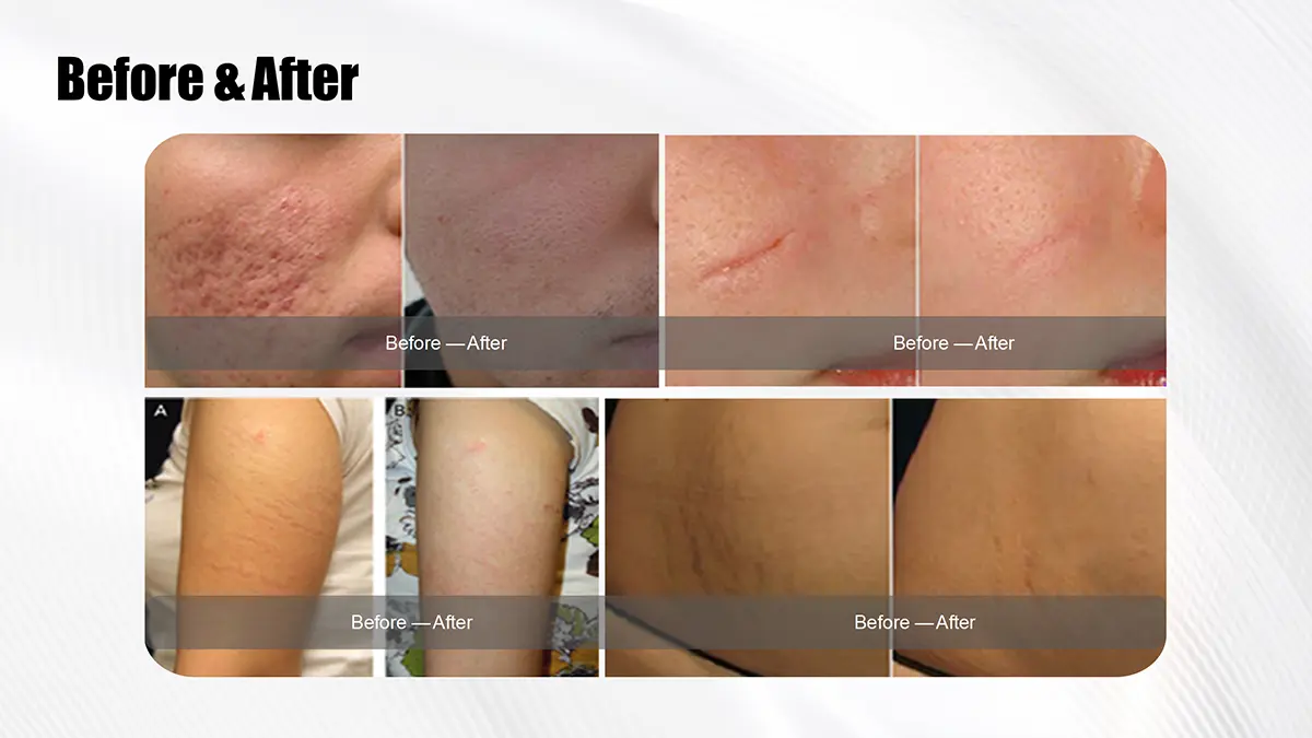 Laser Skin Resurfacing: Dramatic Before and After Results