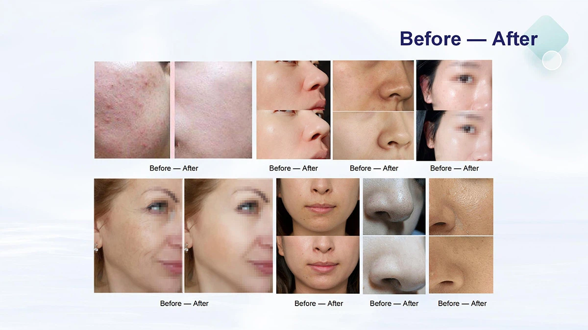 Dermabrasion Effectiveness: Before and After Comparisons