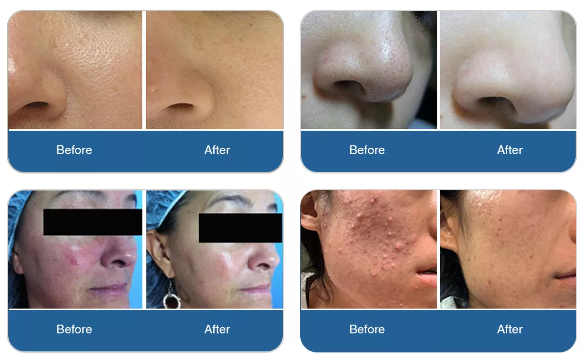 Remarkable Hydrodermabrasion Before and After Transformations