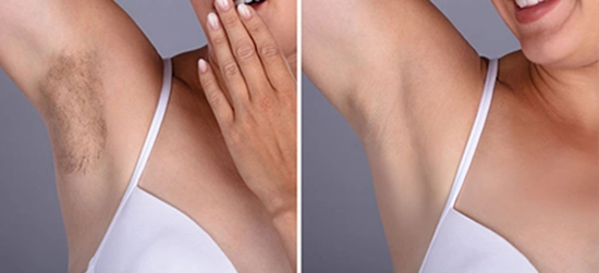 The Evolution of Laser Hair Removal: 4 Wavelength Diode Lasers