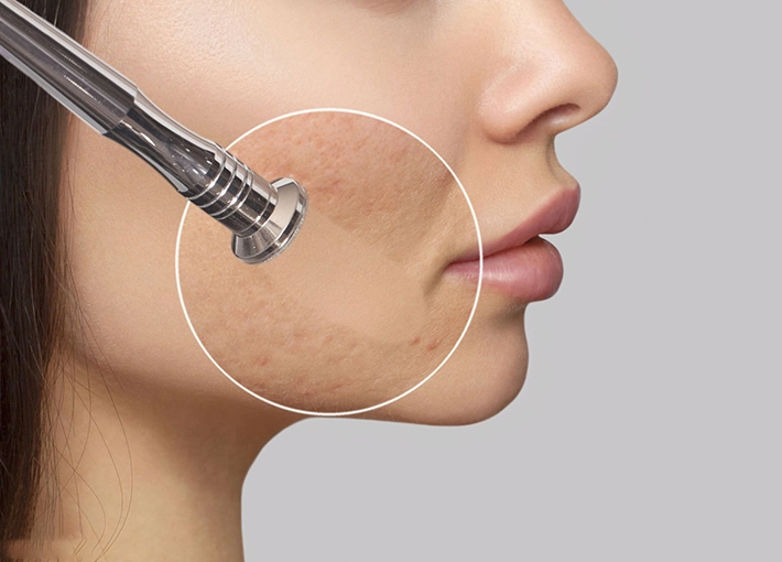 How Does Radio Frequency Skin Tightening Work?