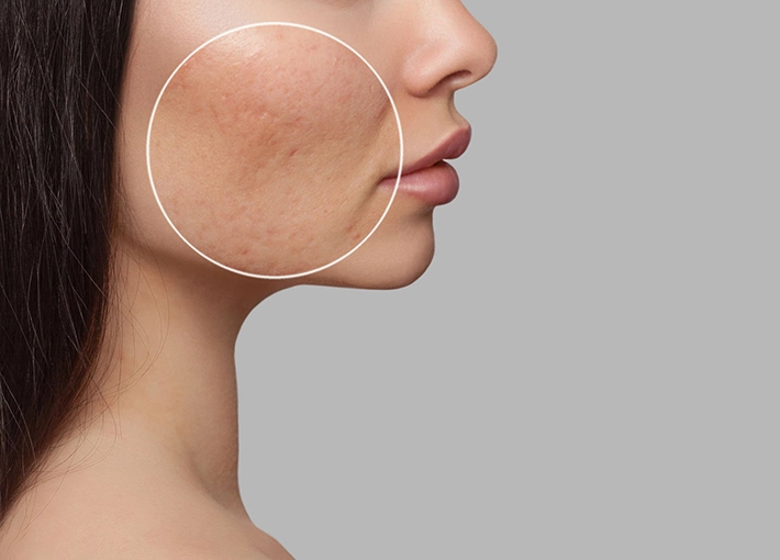 How Does E-Light Photo-Rejuvenation For Hyperpigmentation Treatment Works?