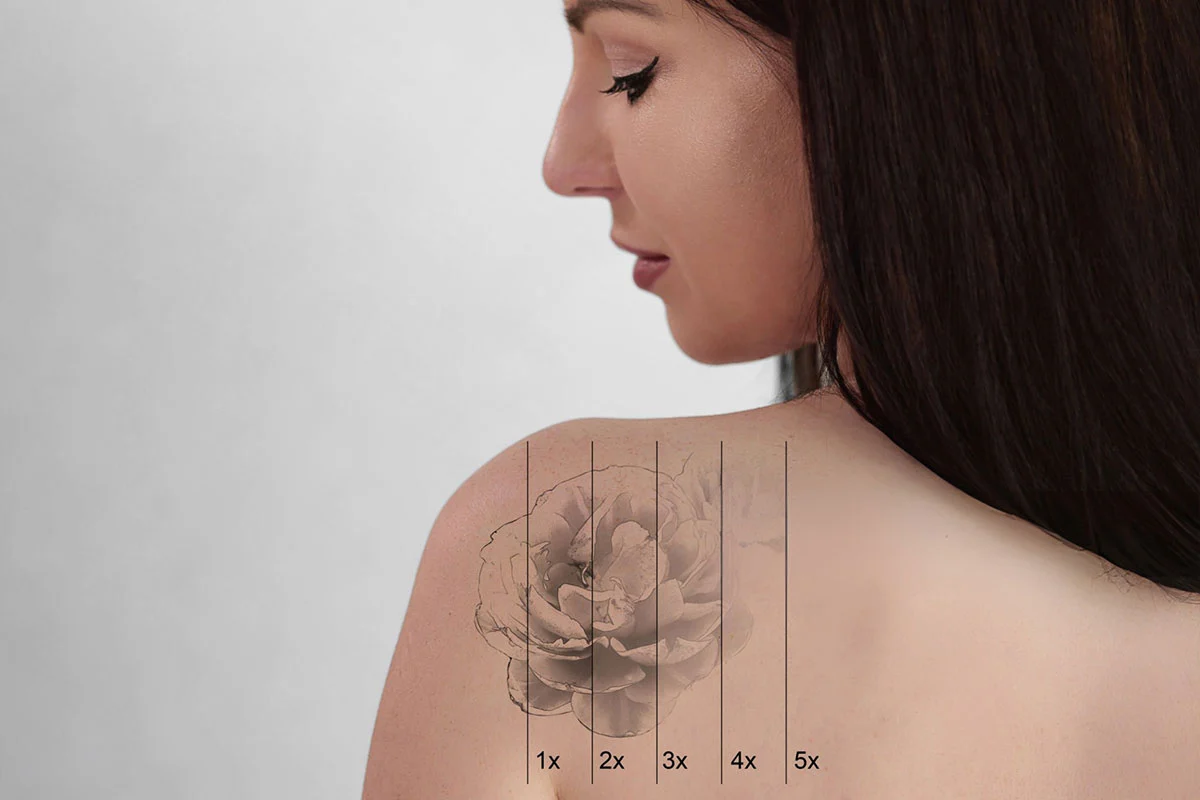 Tattoo and Pigmentation Removal Treatment Solution with Picosecond Laser Technology