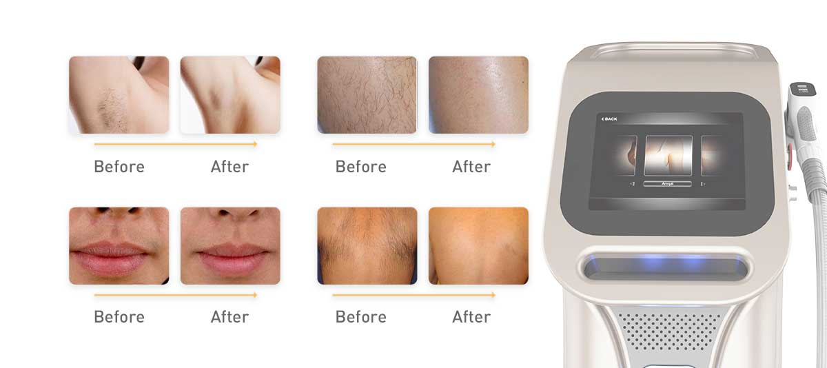 808 Diode Laser Hair Removal of China