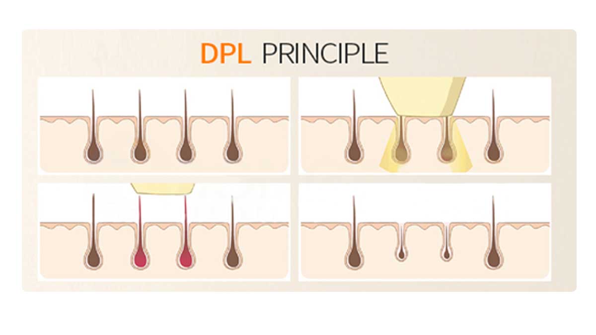 DPL Laser Hair Removal of China