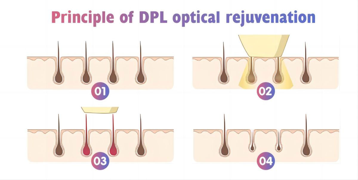 DPL Laser Machine of China