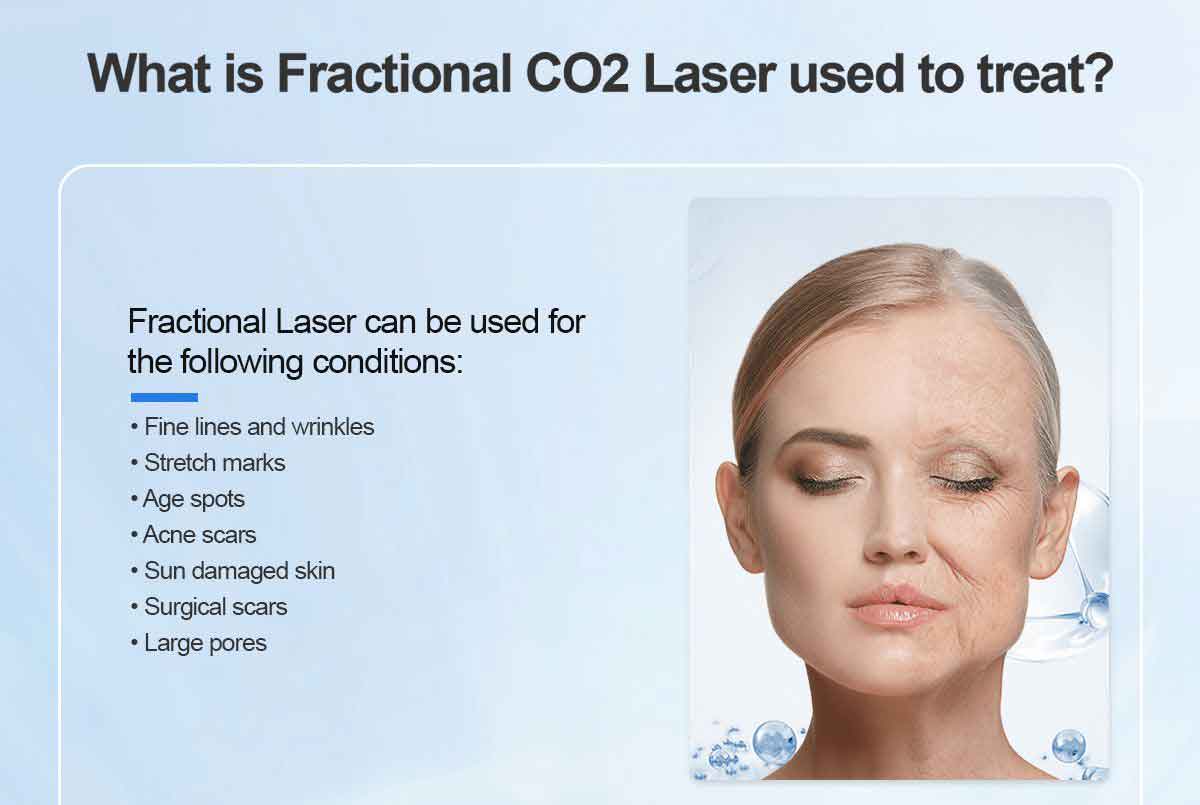 Fractional Co2 Laser Machine Cost