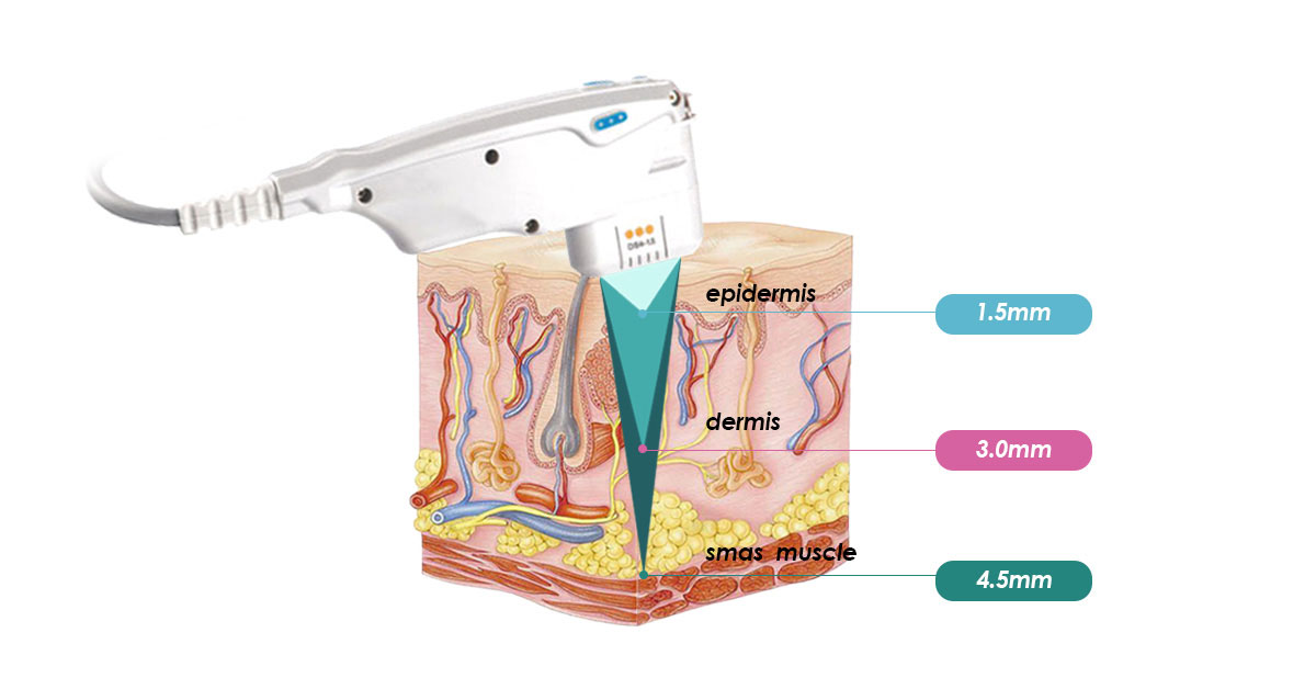 Professional Hifu Machine