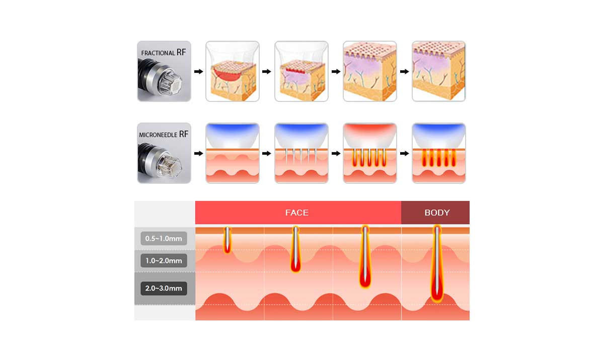 Rf Microneedling Machine