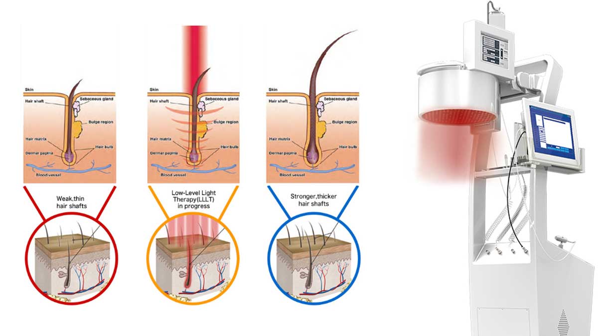 Hair Laser Regrowth Machine of Company