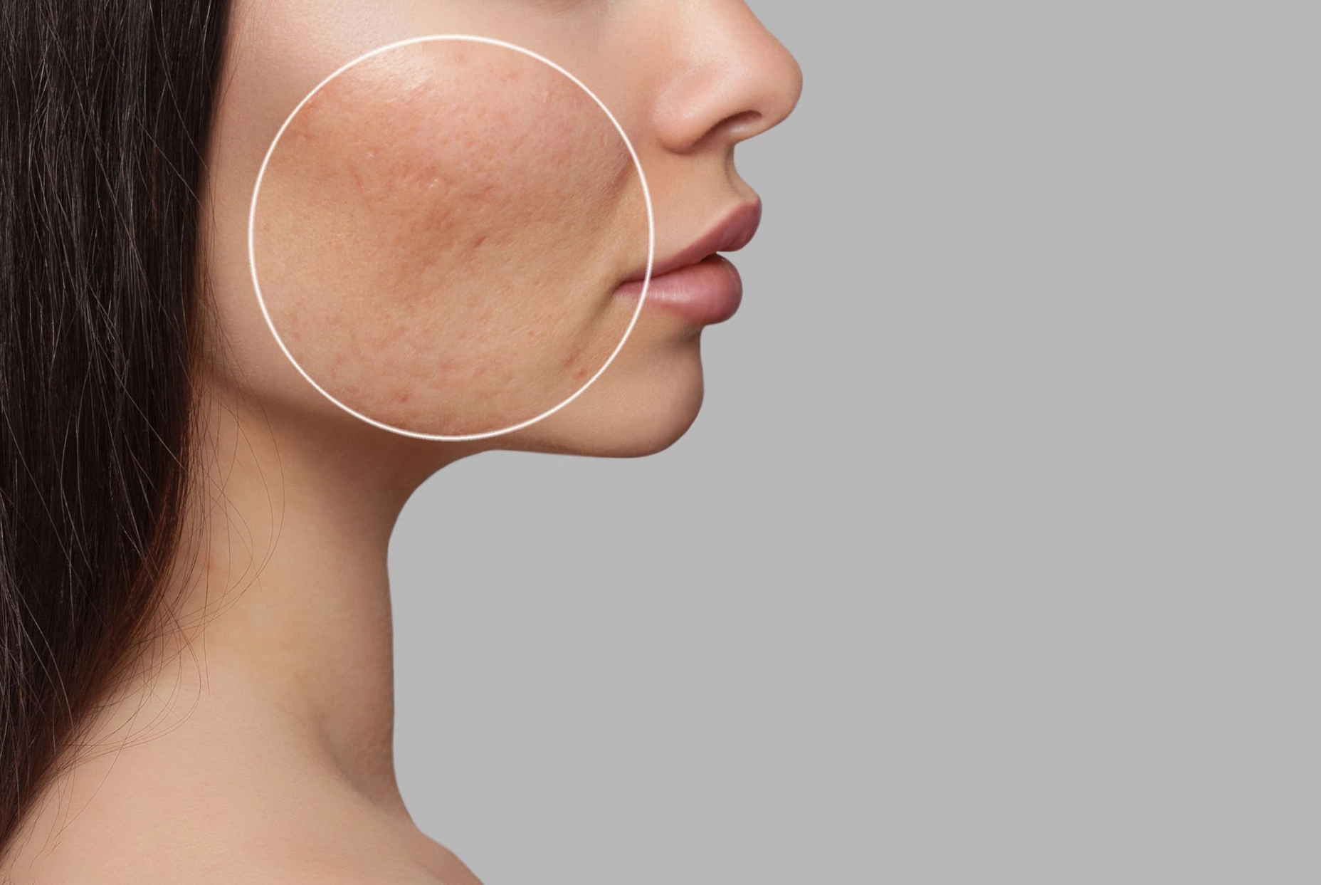 Acne Scars Removal Treatment Solution with IPL, DPL & Fractional CO2 Laser Techniques