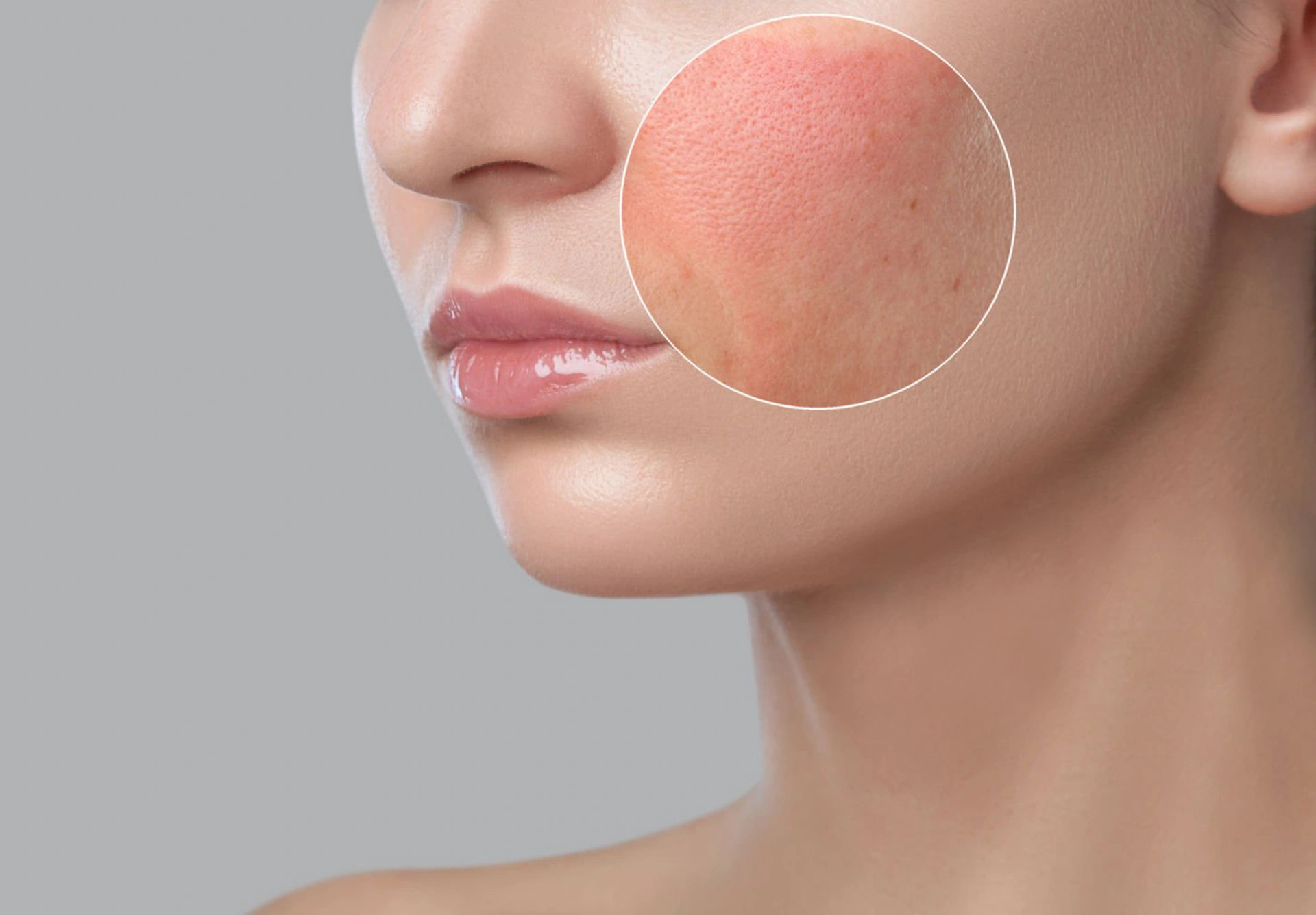 Vascular Removal, Face Redness & Veins Treatment with 980nm Technology