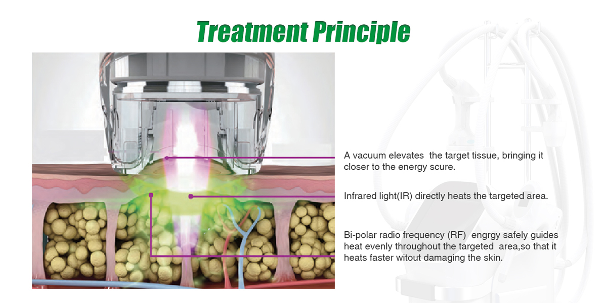 v shaping + rf roller system