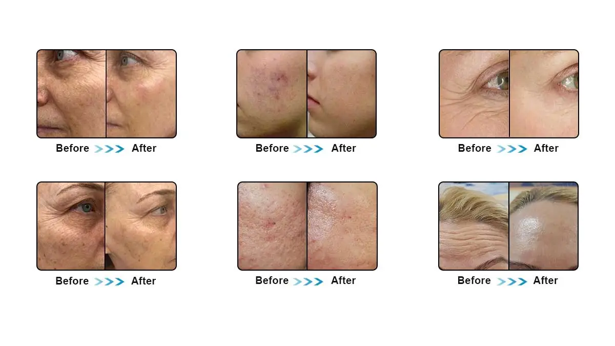 Skin Needling Treatment Before and After Results & Essential Aftercare Tips