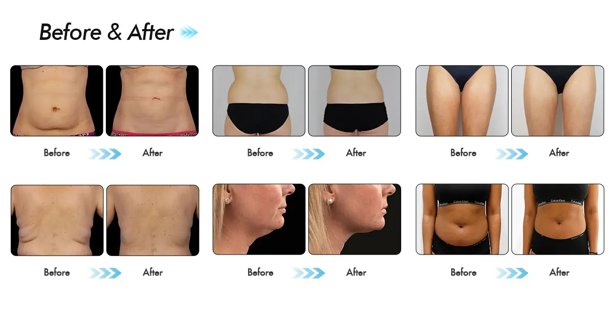 CoolSculpting Upper Arms: Before and After Photos