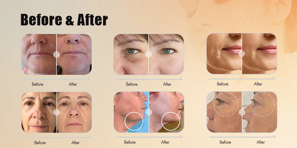 Exploring Various Laser Treatments for the Face with Before and After Photos