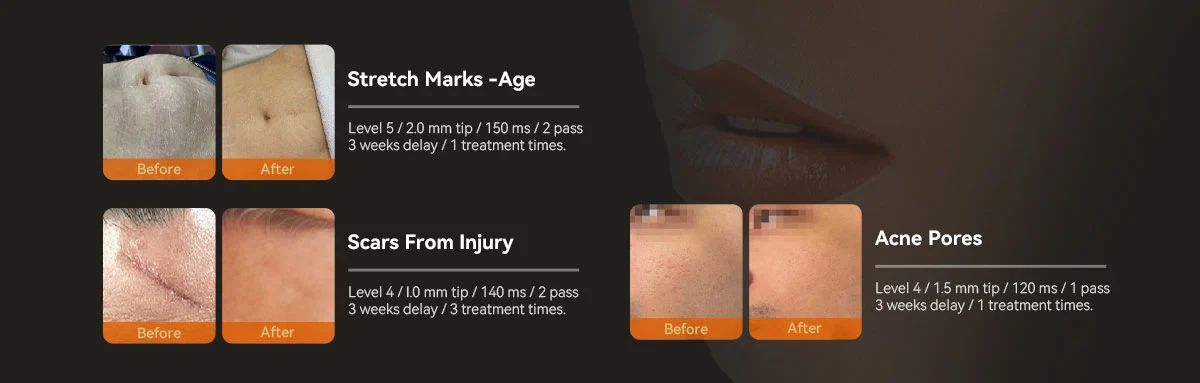 Microneedling for Scars: Before and After Success Gallery