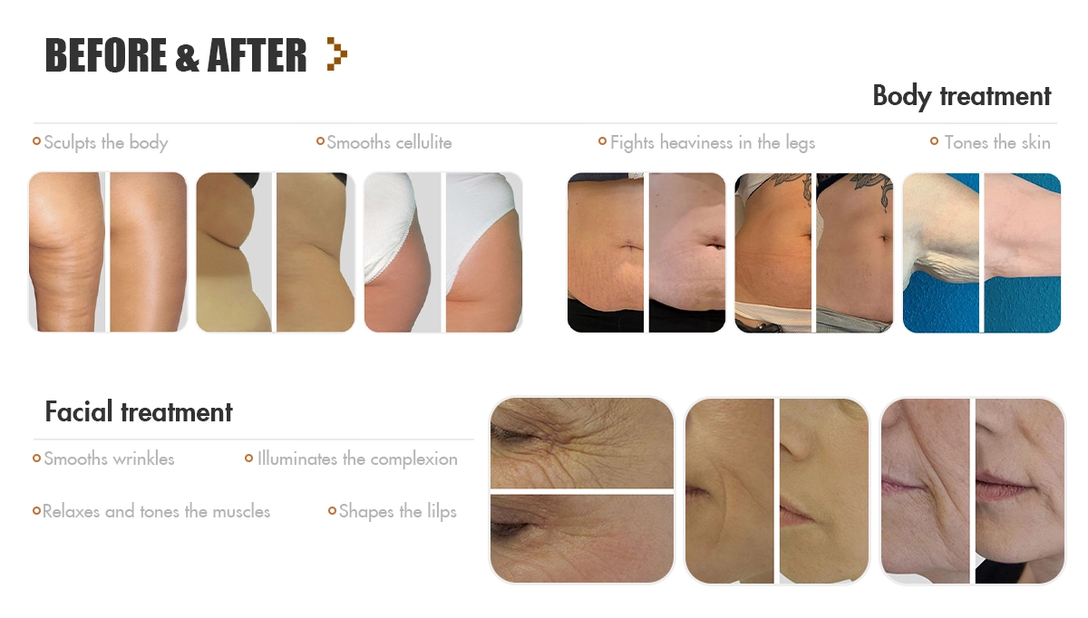 Cellulite Treatment Before and After Effective Solutions