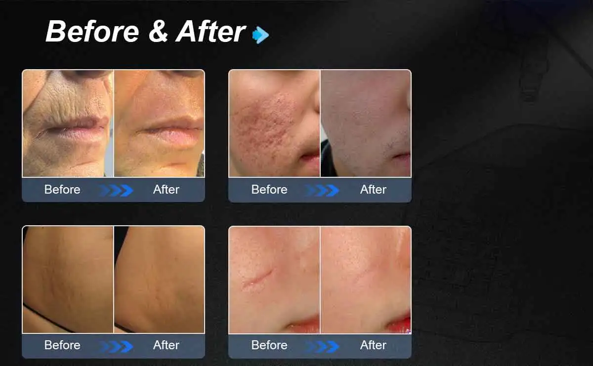 Stretch Marks Erased: The Power of CO2 Laser Treatment Before and After