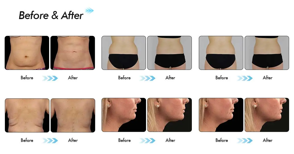 Cool Sculpting Before and After: Transformative Results Across Different Body Areas