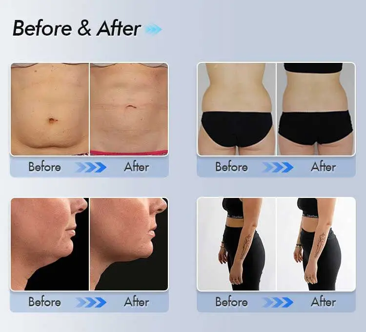 From Double Chin to Defined Jawline: CoolSculpting Before and After