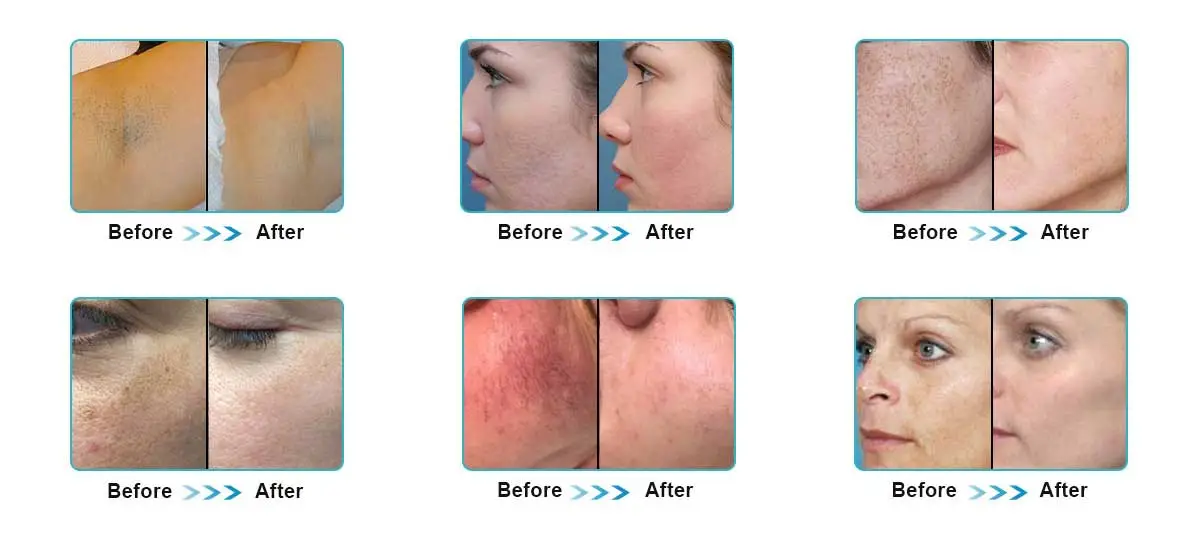 Stunning Transformations: Laser Facial Rejuvenation Before and After Effects