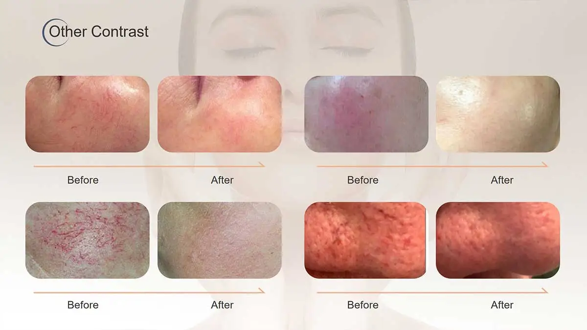 A Clear Difference: Telangiectasia Laser Treatment Before and After