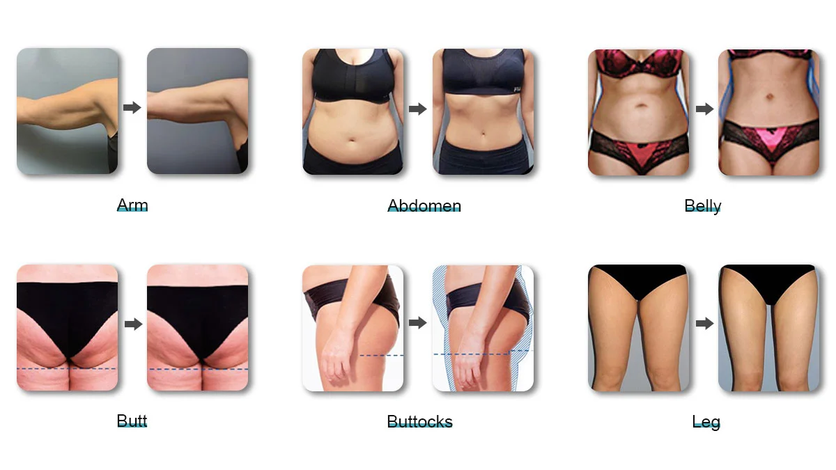 Sculpt Your Body: The Impact of Lipolysis Laser Treatment Before and After