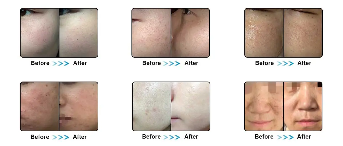 Dramatic Facial Mesotherapy Before and After Effects