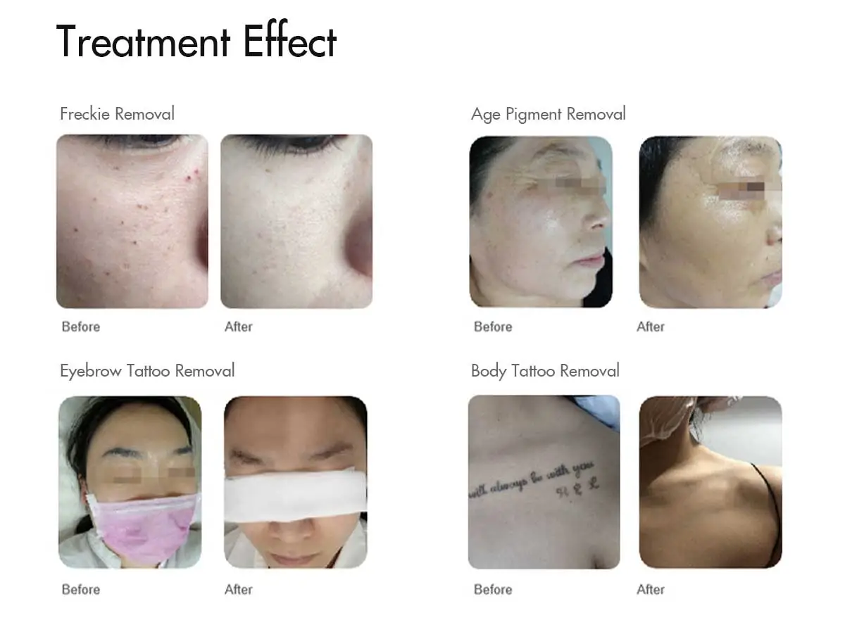 Dark Skin Radiance: YAG Laser Treatment Before and After