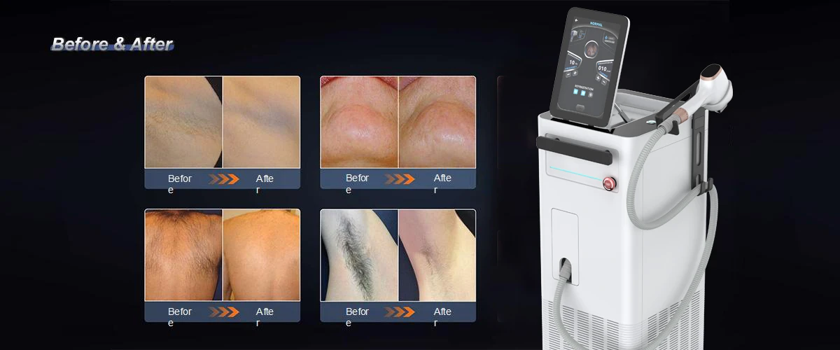 laser medical diode ice laser.jpg